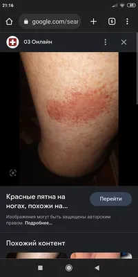 Плохо видно на фото. У меня сначала появляется боль, потом синяки, в  сновном на ногах ниже колен. Вокруг ещё как будто капилляры лопнули.… |  Instagram