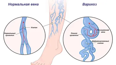 Как проходит удаление сосудистых звездочек на ногах лазером | Центр  Флебологии | Дзен