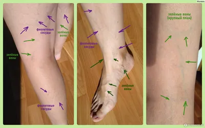 Как укрепить вены и сосуды на ногах при варикозе | «Институт Вен»