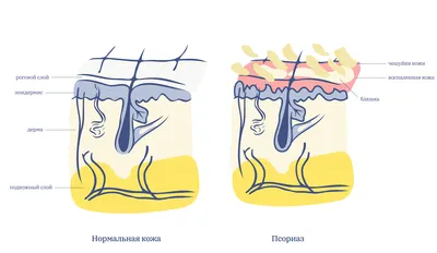 Покраснела кожа. Это псориаз? | Купрум