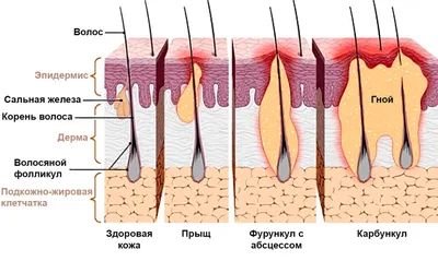 Фурункул и карбункул: фото, в ухе, на лице, на попе; лечение