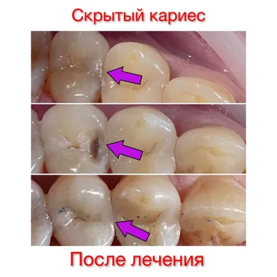 ЧЕМ ОПАСЕН СКРЫТЫЙ КАРИЕС? ИСТОРИЯ НАШЕГО ПАЦИЕНТА, КОТОРЫЙ СЧИТАЛ, ЧТО ОН  ПОЛНОСТЬЮ ЗДОРОВ! - Стоматологическая клиника Лазурит