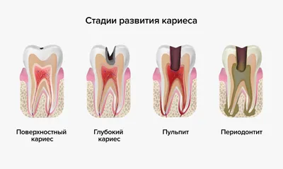 Кариес зубов: как лечить 🔺 Причины и симптомы - AND Стоматологія