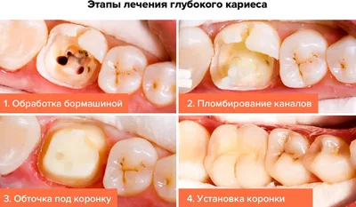 Глубокий кариес - Терапевтическая стоматология - «Аксиома Дентал»