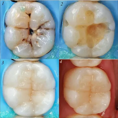 Современные и результативные методики лечения кариеса