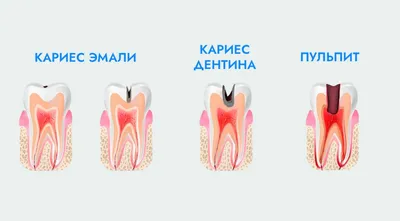 Классификация и этапы развития кариеса - полезная информация от врачей  стоматологической клиники доктора Фролова