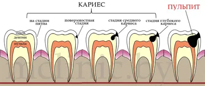 Апроксимальный кариес — сложности в выявлении и профилактике — Эстетическая  стоматология Deva-Dent в Москве