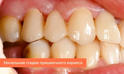 Фиссурный кариес. лечение, профилактика | Стоматологический центр 32 в  Йошкар-Оле - современная стоматология