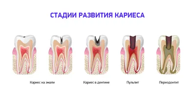 Лечение кариеса зубов в Москве: цены, отзывы | Альянс бьюти-ортопедов,  Москва