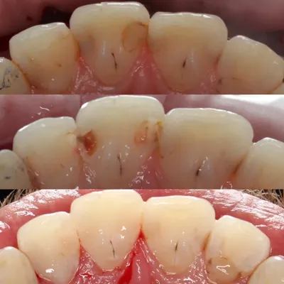 Лечение глубокого кариеса – Вероника