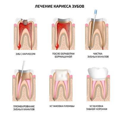 Лечение кариеса и реставрация передних зубов - примеры работ стоматологии  AVS clinic в Санкт-Петербурге