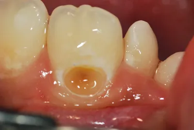 Пришеечный кариес фото, как лечить, причины возникновения | Dental Art