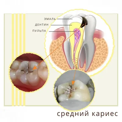 Кариес дентина 26, 27 зубов, до и после лечения - MagicDent