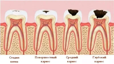 Кариес зубов: виды, симптомы и лечение | Стоматология Smile Office