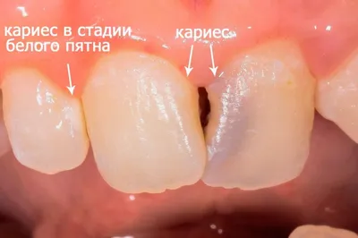 Ретроградный кариес: особенности, симптомы, лечение - энциклопедия  Ochkov.net