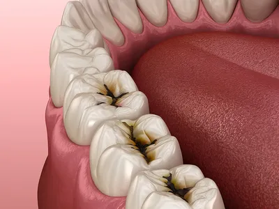 Кариес осложненный глубокий