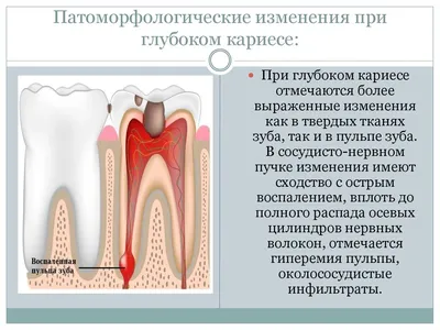 Как развивается кариес