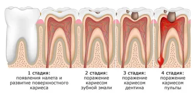 Пришеечный кариес: стадии и методы лечения