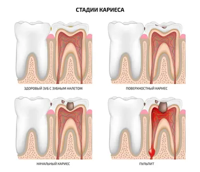 Кариес корня зуба- симптомы, причины, методы лечения кариеса зуба