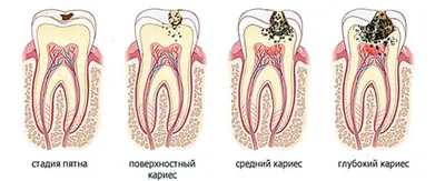 Генерализованный кариес