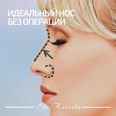 Новый нос. Три месяца спустя. Дневник пациентки | Beauty Insider