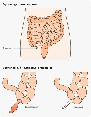 Аппендицит: симптомы, признаки, с какой стороны болит, операция по  удалению, как определить