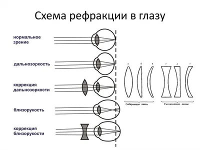 Расфокусировка зрения – что это такое, причины, диагностика, лечение