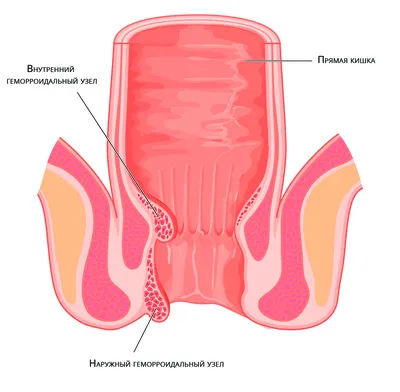 Геморрой у женщин: причины, симптомы, признаки, что делать, как избавиться,  лечение