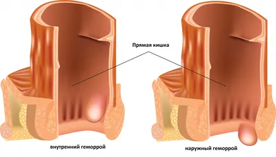 Геморрой: причины, симптомы, диагностика и лечение