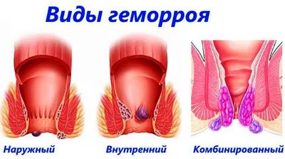 Тромбированный геморрой: причины, диагностика, симптомы и лечение