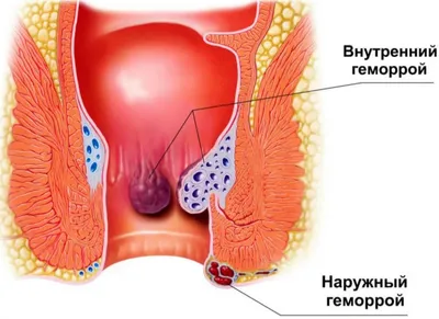 Геморрой лечение геморроя у мужчин и женщин в Москве цена в Клинике ABC