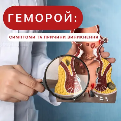 Геморрой: что такое? Как бороться? - статьи от компании Еламед