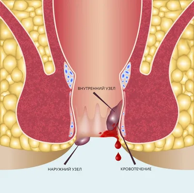 Лечение внутреннего геморроя — симптомы, причины и методы лечения болезни