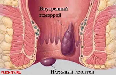 Картинки геморроя