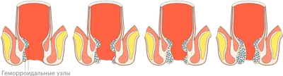 Лечение геморроя современными методами в Москве