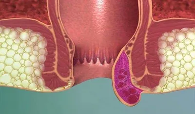 9 методов лечения геморроя у женщин и мужчин: рейтинг, отзывы, советы врачей
