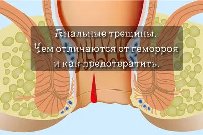 Лечение геморроя со свищем в медицинском центре «Я здоров», цены в  Новосибирске