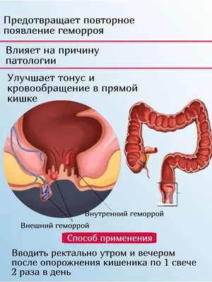 Геморрой симптомы, лечение у женщин и мужчин, какие есть средства,  профилактика