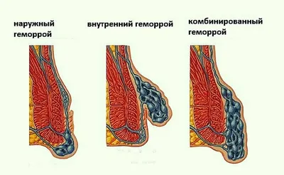 ТОП-14 препаратов от геморроя - рейтинг хороших средств 2021