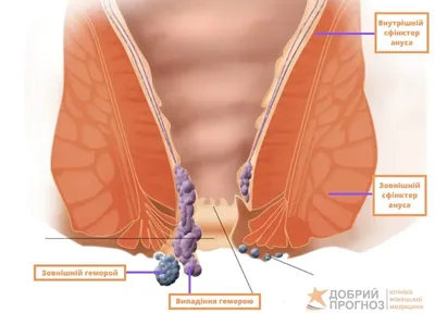 Геморрой: причины, виды, методы лечения и последствия для здоровья