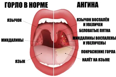 Лечение горла