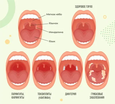 Фарингит: признаки, симптомы, лечение - МедКом