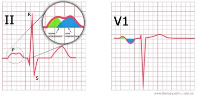 ЭКГ-диагностика гипертрофии левого предсердия