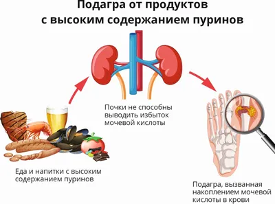 Лечение подагры (подагрического артрита) в Омске | цены на услуги врача в  клинике Центр EzraMed Clinic