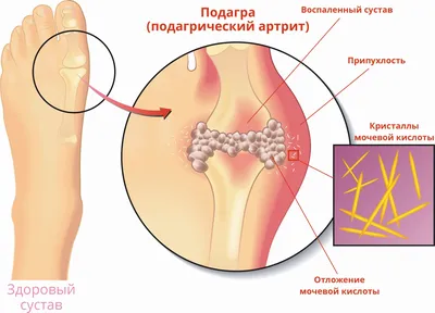 Опухший сустав пальца руки: причины, диагностика и методы лечения