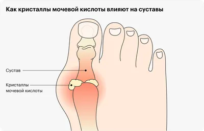 Подагра: что это за болезнь, признаки, причины, симптомы, диагностика,  лечение