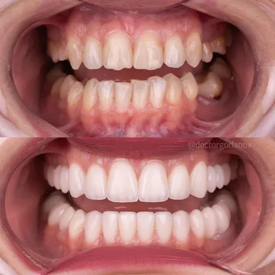 Пин от пользователя Eric Ortiz на доске Baloncesto | Здоровые зубы,  Ортодонтия, Белые зубы