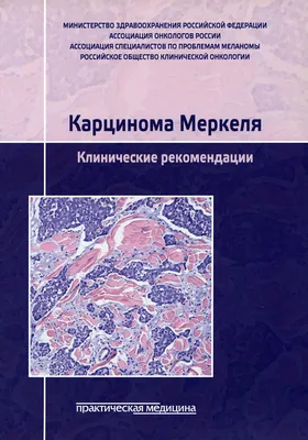 Карцинома: виды, лечение, прогноз и основные локализации