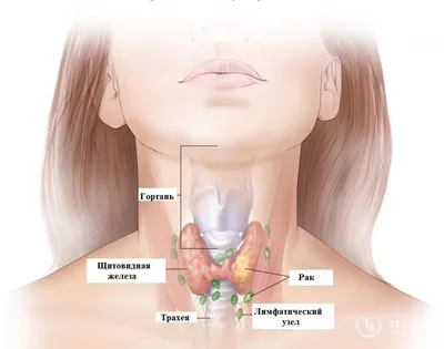 карцинома - Morpheme Art