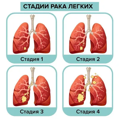 Кровохарканье — Википедия